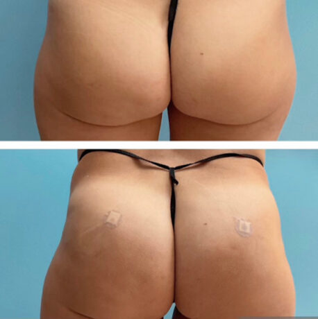 Brazilian Butt Lift ( Fat Transfer or Liquid) at Face Works Plastic Surgery, Plastic Surgeon Near Me in Schaumburg, IL