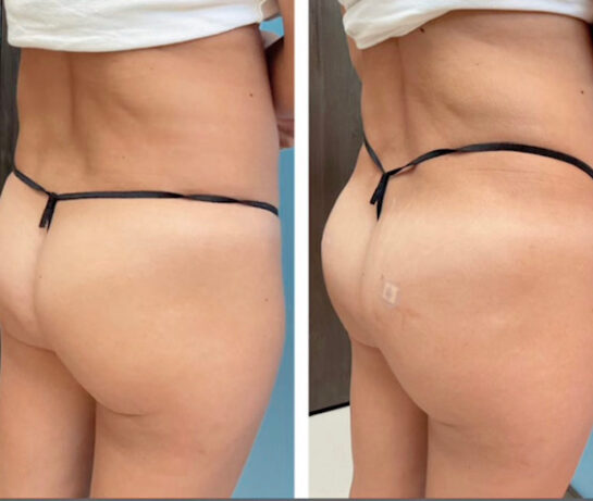 Brazilian Butt Lift ( Fat Transfer or Liquid) at Face Works Plastic Surgery, Plastic Surgeon Near Me in Schaumburg, IL