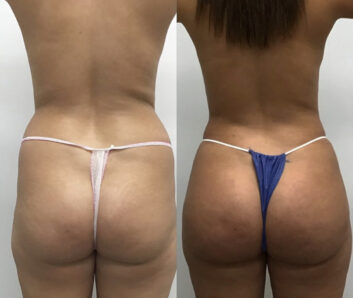Brazilian Butt Lift ( Fat Transfer or Liquid) at Face Works Plastic Surgery, Plastic Surgeon Near Me in Schaumburg, IL