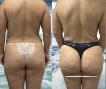 Brazilian Butt Lift ( Fat Transfer or Liquid) at Face Works Plastic Surgery, Plastic Surgeon Near Me in Schaumburg, IL