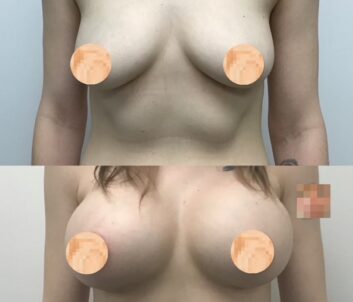 Breast Augmentation - Lift at Face Works Plastic Surgery, Plastic Surgeon Near Me in Schaumburg, IL