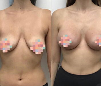 Breast Augmentation - Lift at Face Works Plastic Surgery, Plastic Surgeon Near Me in Schaumburg, IL