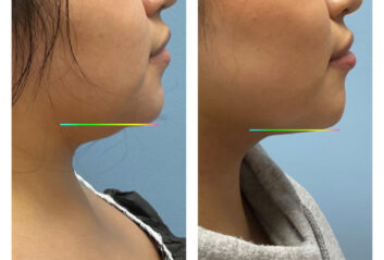 HD LipoX® of Jawline at Face Works Plastic Surgery, Plastic Surgeon Near Me in Schaumburg, IL