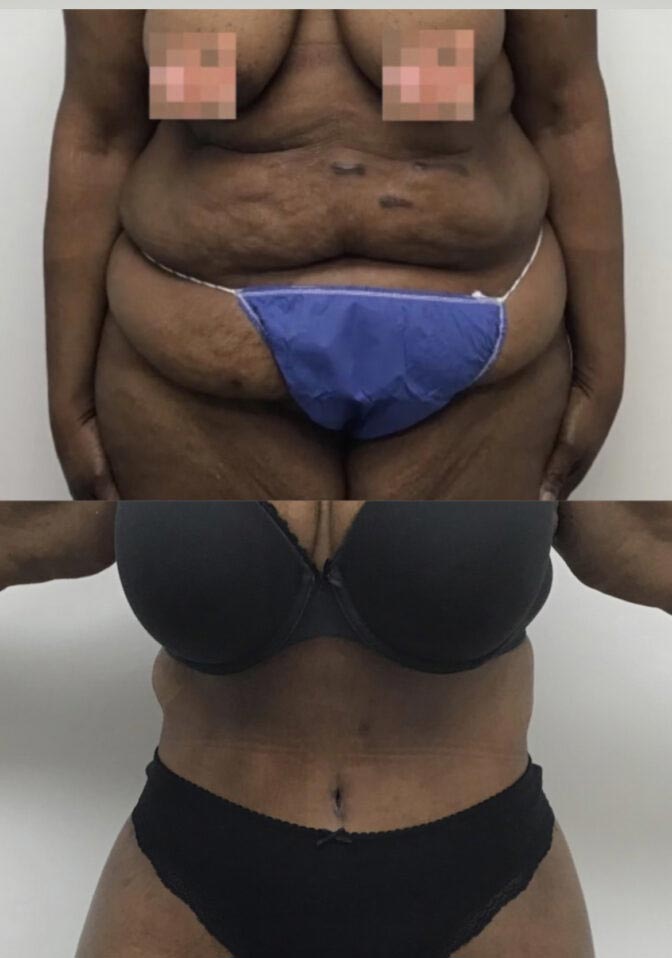 Tummy Tuck at Face Works Plastic Surgery, Plastic Surgeon Near Me in Schaumburg, IL