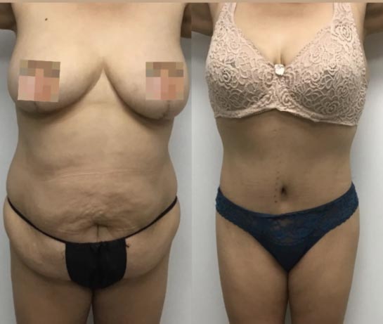Tummy Tuck at Face Works Plastic Surgery, Plastic Surgeon Near Me in Schaumburg, IL