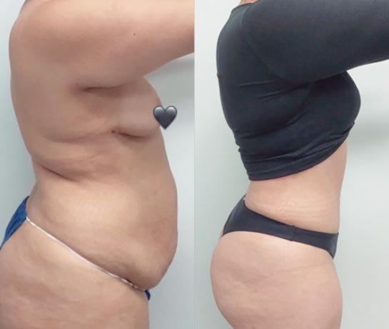 Tummy Tuck at Face Works Plastic Surgery, Plastic Surgeon Near Me in Schaumburg, IL
