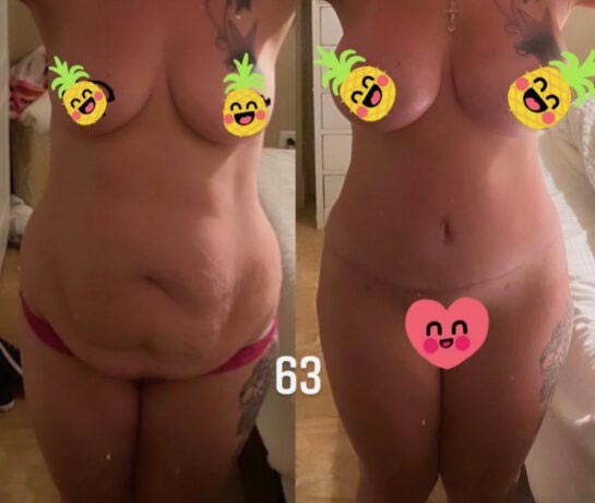 Tummy Tuck at Face Works Plastic Surgery, Plastic Surgeon Near Me in Schaumburg, IL