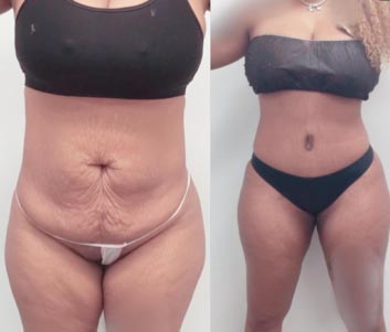 Tummy Tuck at Face Works Plastic Surgery, Plastic Surgeon Near Me in Schaumburg, IL