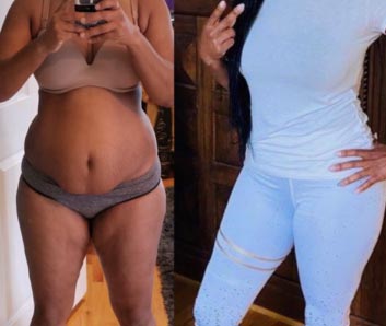 Tummy Tuck at Face Works Plastic Surgery, Plastic Surgeon Near Me in Schaumburg, IL