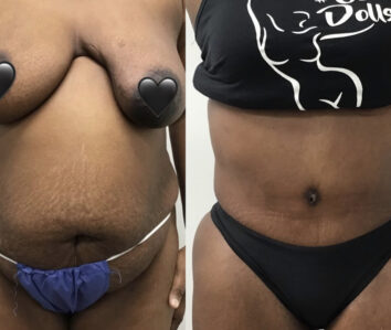 Tummy Tuck at Face Works Plastic Surgery, Plastic Surgeon Near Me in Schaumburg, IL