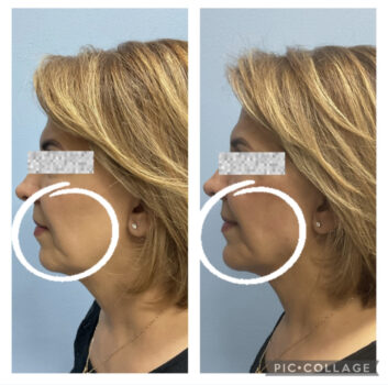 Dermal fillers at Face Works Plastic Surgery, Plastic Surgeon Near Me in Schaumburg, IL Dermal fillers at Face Works Plastic Surgery, Plastic Surgeon Near Me in Schaumburg, IL