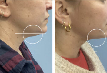 HD LipoX® of Jawline at Face Works Plastic Surgery, Plastic Surgeon Near Me in Schaumburg, IL