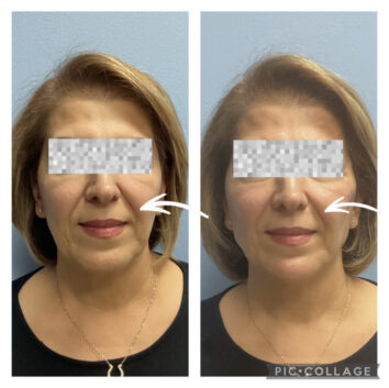 Dermal fillers at Face Works Plastic Surgery, Plastic Surgeon Near Me in Schaumburg, IL Dermal fillers at Face Works Plastic Surgery, Plastic Surgeon Near Me in Schaumburg, IL