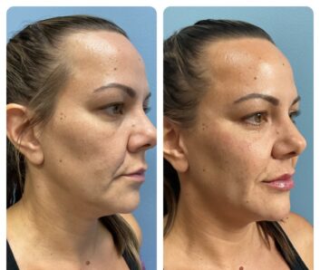 Dermal fillers at Face Works Plastic Surgery, Plastic Surgeon Near Me in Schaumburg, IL