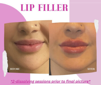 Lip Fillers at Face Works Plastic Surgery, Plastic Surgeon Near Me in Schaumburg, IL