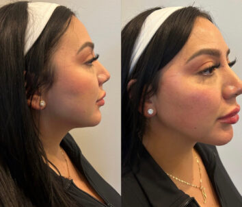 Dermal fillers at Face Works Plastic Surgery, Plastic Surgeon Near Me in Schaumburg, IL