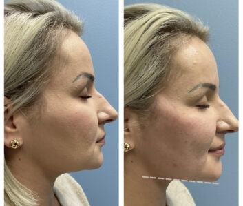 Dermal fillers at Face Works Plastic Surgery, Plastic Surgeon Near Me in Schaumburg, IL