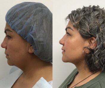 Dermal fillers at Face Works Plastic Surgery, Plastic Surgeon Near Me in Schaumburg, IL