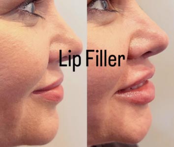 Lip Fillers at Face Works Plastic Surgery, Plastic Surgeon Near Me in Schaumburg, IL
