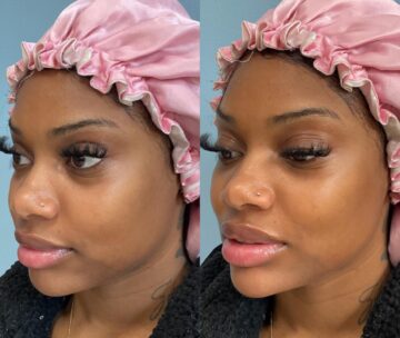 Dermal fillers at Face Works Plastic Surgery, Plastic Surgeon Near Me in Schaumburg, IL