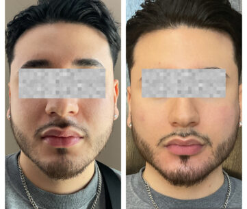 Dermal fillers at Face Works Plastic Surgery, Plastic Surgeon Near Me in Schaumburg, IL