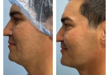 HD LipoX® of Jawline at Face Works Plastic Surgery, Plastic Surgeon Near Me in Schaumburg, IL