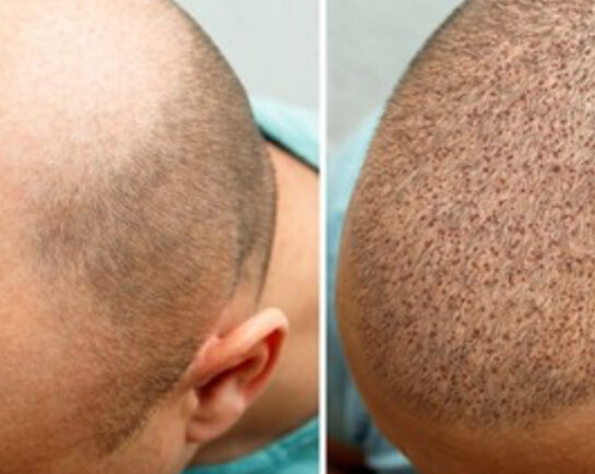Hair Transplant/Restoration (Exosome or PRP) at Face Works Plastic Surgery, Plastic Surgeon Near Me in Schaumburg, IL