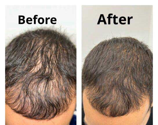 Hair Transplant/Restoration (Exosome or PRP) at Face Works Plastic Surgery, Plastic Surgeon Near Me in Schaumburg, IL