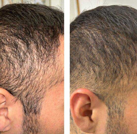 Hair Transplant/Restoration (Exosome or PRP) at Face Works Plastic Surgery, Plastic Surgeon Near Me in Schaumburg, IL