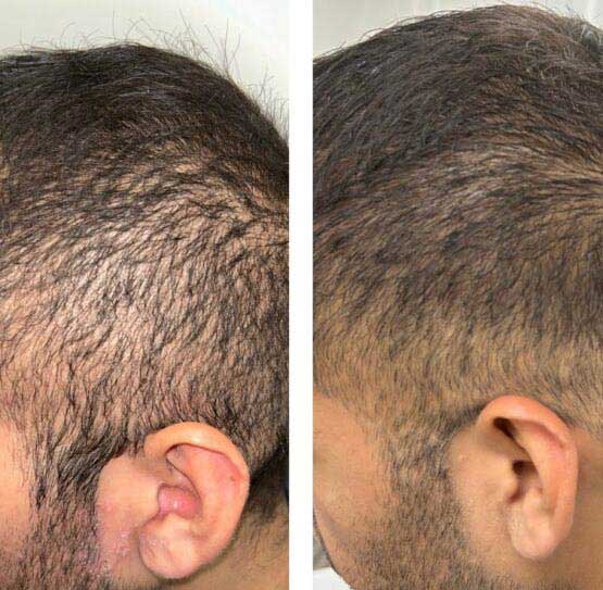 Hair Transplant/Restoration (Exosome or PRP) at Face Works Plastic Surgery, Plastic Surgeon Near Me in Schaumburg, IL
