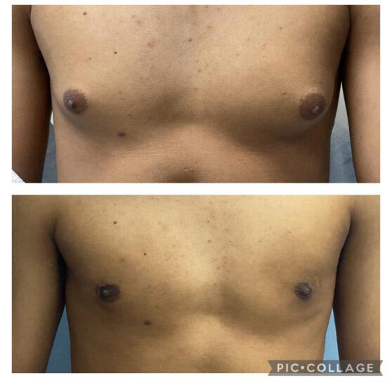 Hair Transplant/Restoration (Exosome or PRP) at Face Works Plastic Surgery, Plastic Surgeon Near Me in Schaumburg, IL