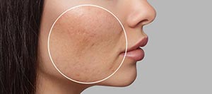 Scar Revision Treatment Specialist Near Me in Schaumburg, IL