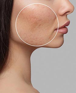 Scar Revision Near Me in Schaumburg, IL
