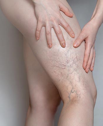 Spider Veins (Sclerotherapy) Near Me in Schaumburg, IL
