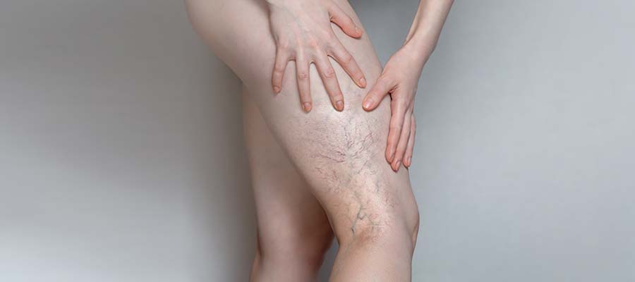 Spider Veins (Sclerotherapy) Treatment Specialist Near Me in Schaumburg, IL