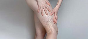 Spider Veins (Sclerotherapy) Treatment Specialist Near Me in Schaumburg, IL