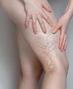 Spider Veins (Sclerotherapy) Near Me in Schaumburg, IL
