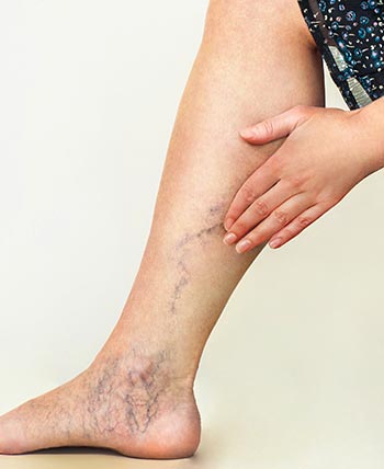 Varicose Veins (Phlebotomy) Near Me in Schaumburg, IL
