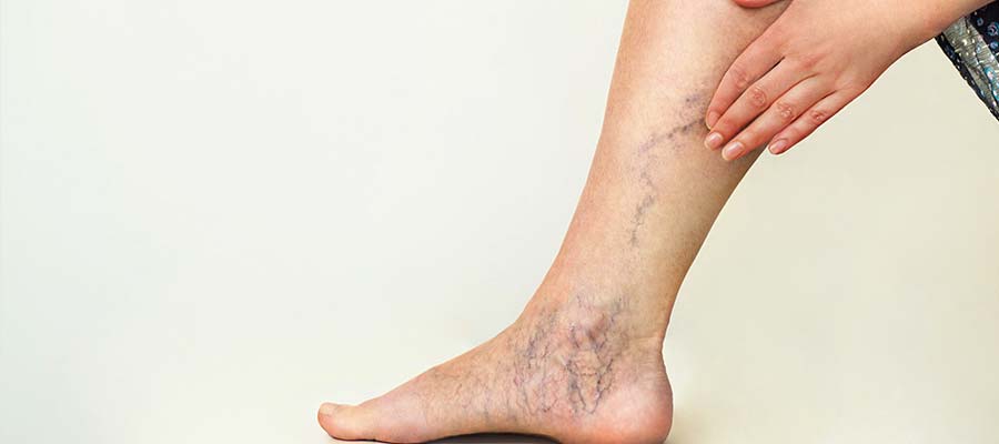 Varicose Veins (Phlebotomy) Treatment Specialist Near Me in Schaumburg, IL
