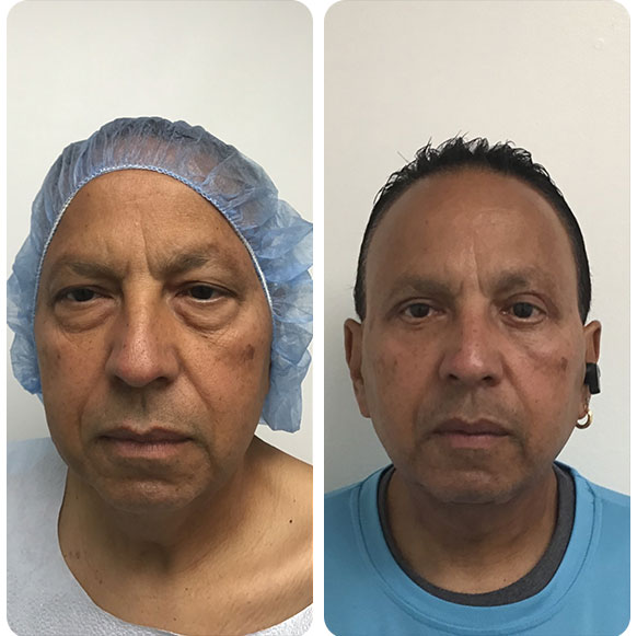 Face Lift at Face Works Plastic Surgery, Plastic Surgeon Near Me in Schaumburg, IL