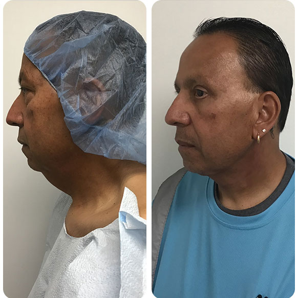 Face Lift at Face Works Plastic Surgery, Plastic Surgeon Near Me in Schaumburg, IL