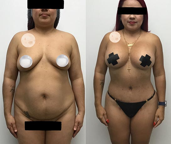 Mommy Makeover at Face Works Plastic Surgery, Plastic Surgeon Near Me in Schaumburg, IL