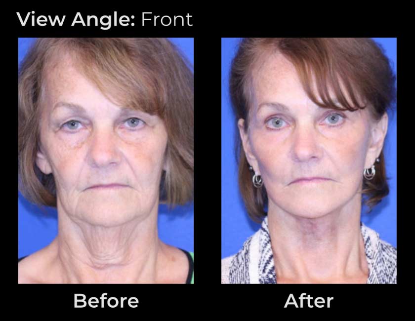 Before and After Face & Neck Lift at Face Works Plastic Surgery Near Me in Schaumburg, IL