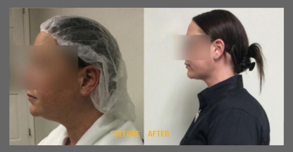 Before and After HD LipoX® of Jawline at Face Works Plastic Surgery, Plastic Surgeon Near Me in Schaumburg, IL