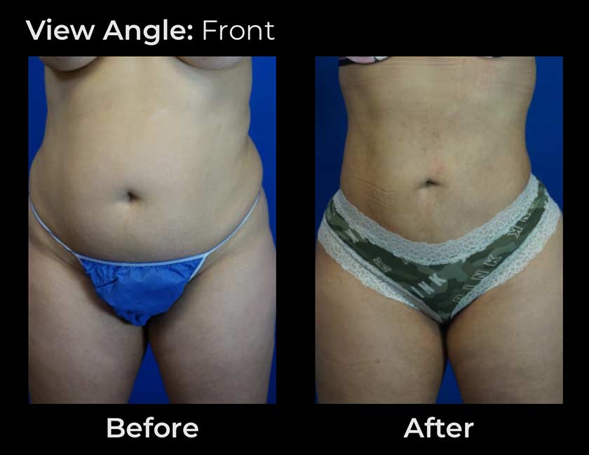 Before and After Body Liposuction at Face Works Plastic Surgery, Near Me in Schaumburg, IL