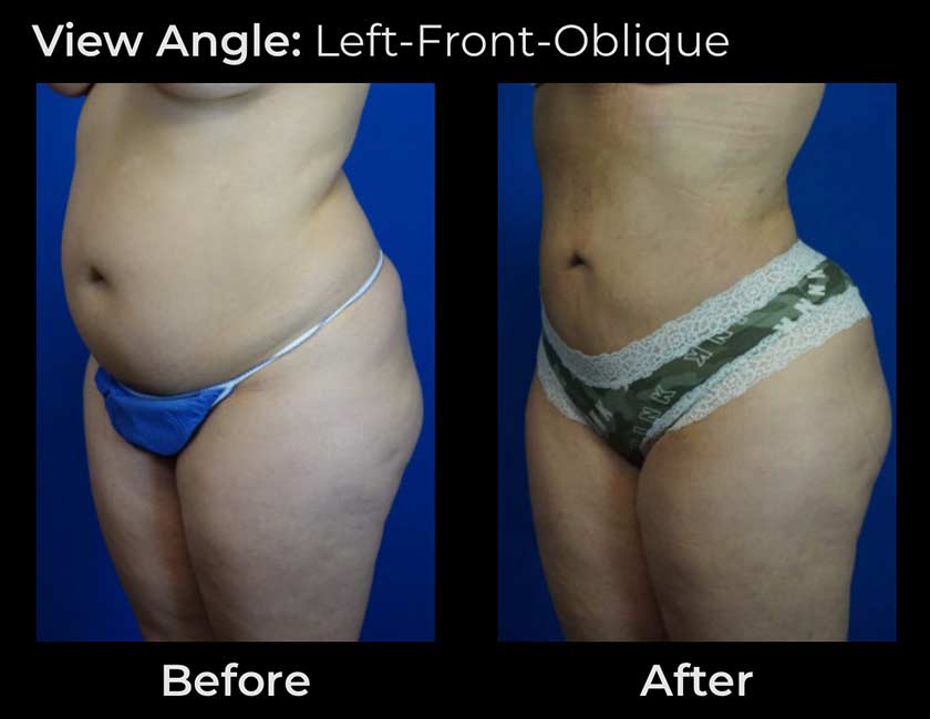 Before and After Body Liposuction at Face Works Plastic Surgery, Near Me in Schaumburg, IL