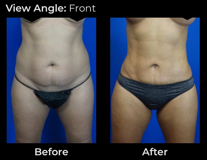 Before and After Body Liposuction at Face Works Plastic Surgery, Near Me in Schaumburg, IL