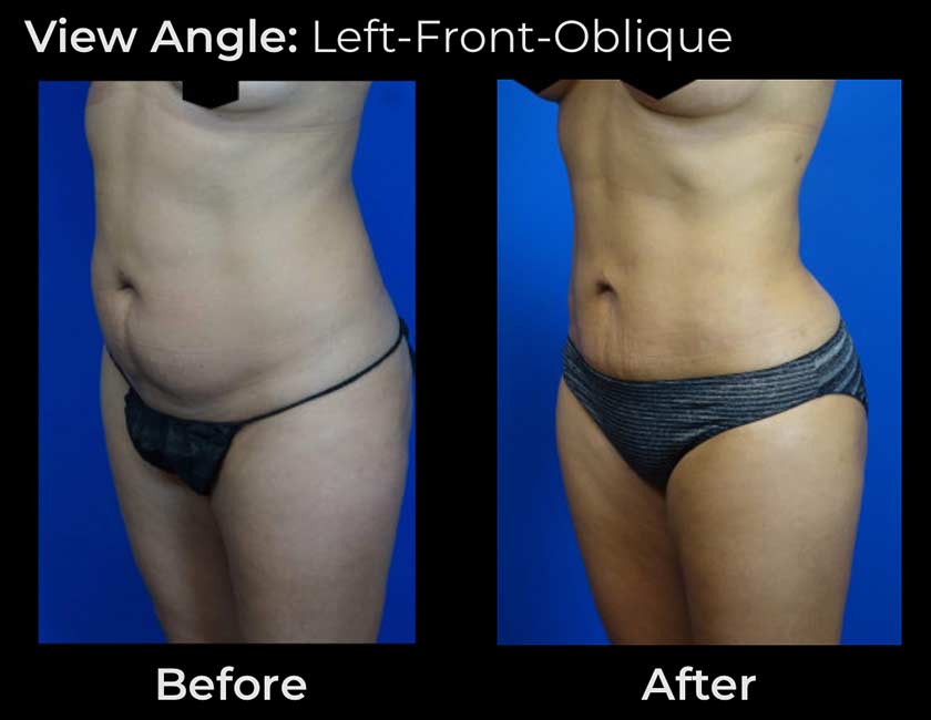 Before and After Body Liposuction at Face Works Plastic Surgery, Near Me in Schaumburg, IL