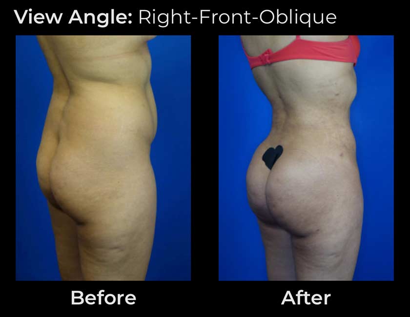 Before and After Brazilian Butt Lift ( Fat Transfer or Liquid) at Face Works Plastic Surgery, Plastic Surgeon Near Me in Schaumburg, IL