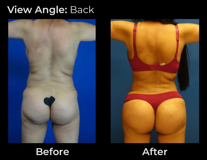 Before and After Brazilian Butt Lift ( Fat Transfer or Liquid) at Face Works Plastic Surgery, Plastic Surgeon Near Me in Schaumburg, IL